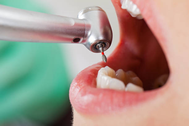 Best Emergency Tooth Extraction in Rochester, NH